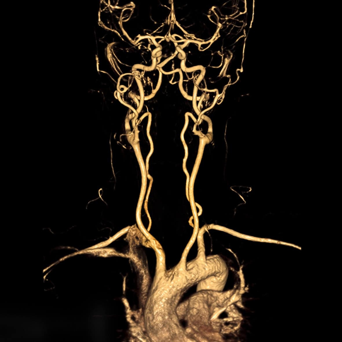brain mri